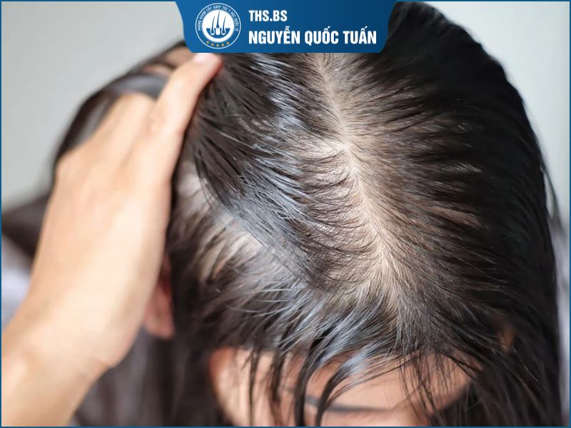 Tóc mỏng là gì? Dấu hiệu nhận biết tình trạng tóc mỏng 