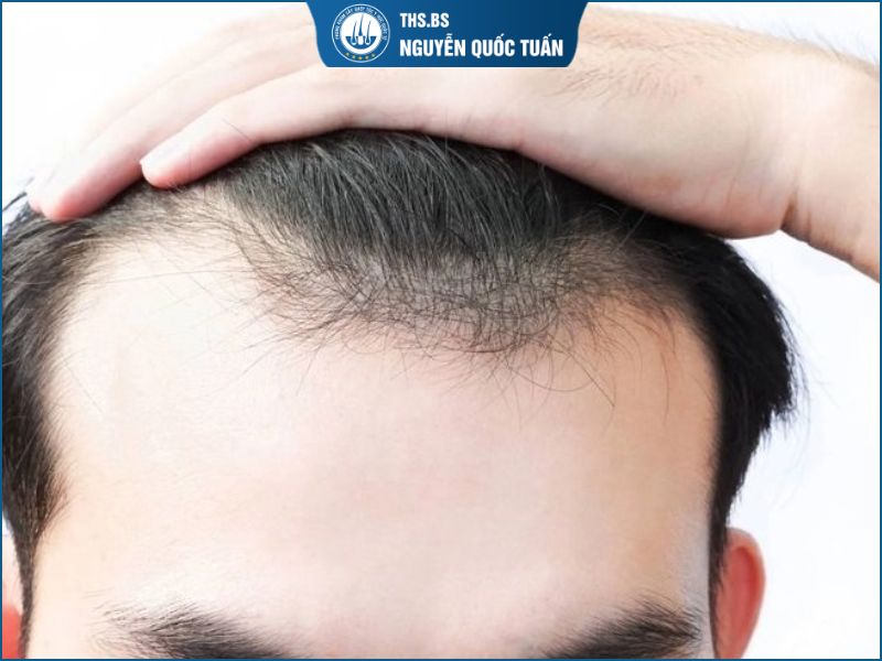 Vì sao người trán cao dô cần chỉnh sửa đường chân tóc?