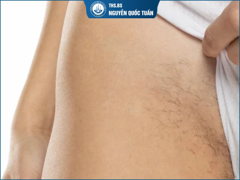 Trường hợp nào phù hợp với phương pháp cấy lông vùng kín 