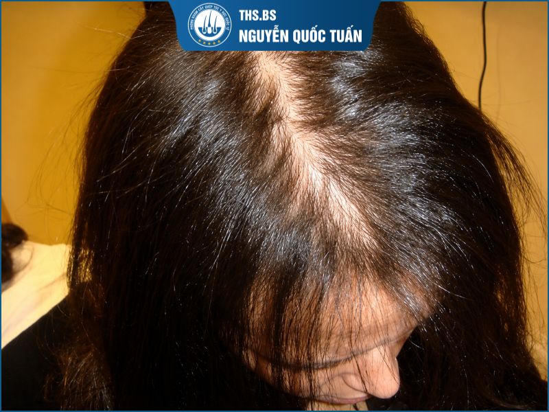  Khi nào người tóc mỏng nên cân nhắc cấy tóc? 