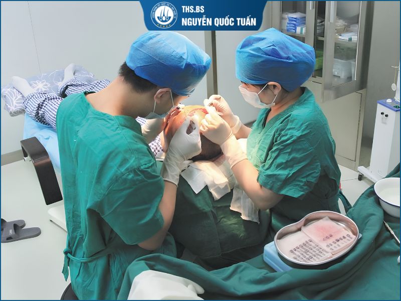 Ưu điểm và nhược điểm của cấy tóc tự thân