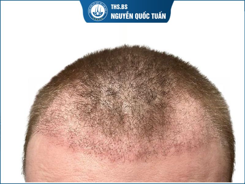 Vì sao có hiện tượng rụng tóc sau 1 tháng? 