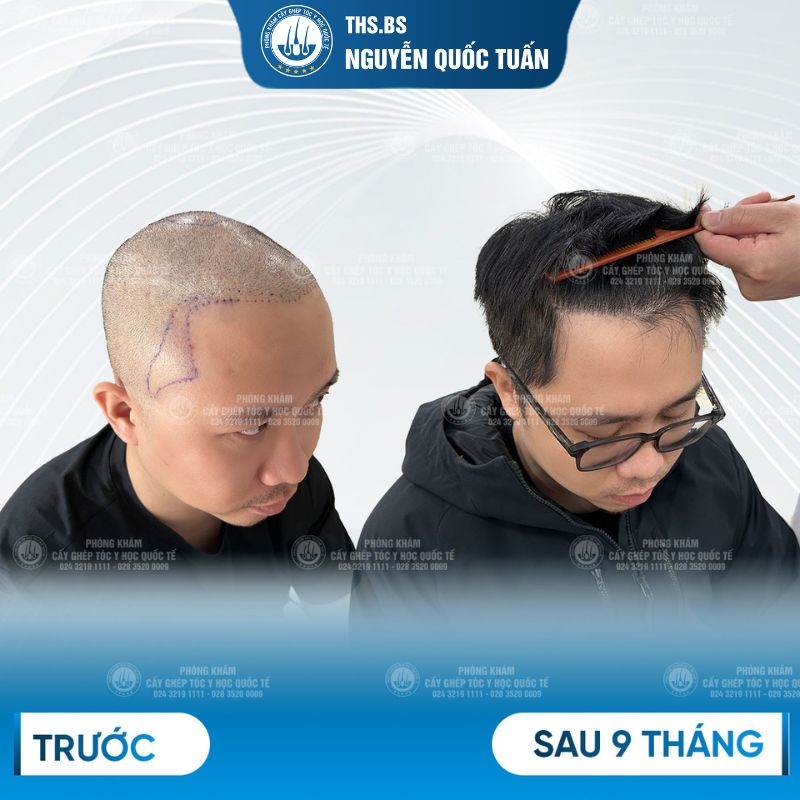 Kết quả sau cấy tại Phòng Khám Cấy Ghép Tóc Y Học Quốc Tế 