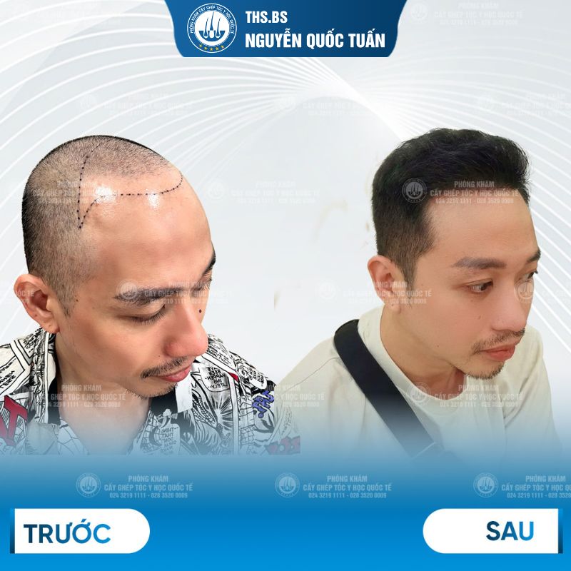Chữa hói đầu nam mất bao lâu? Khi nào cần đổi sang hướng điều trị khác? 