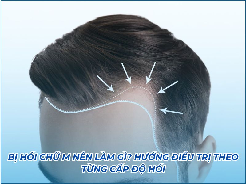 bị hói chữ m nên làm gì