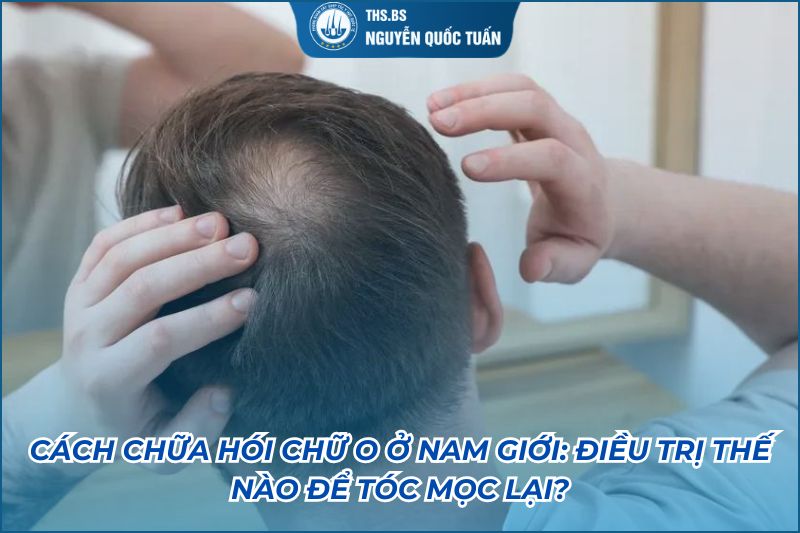 cách chữa hói chữ O