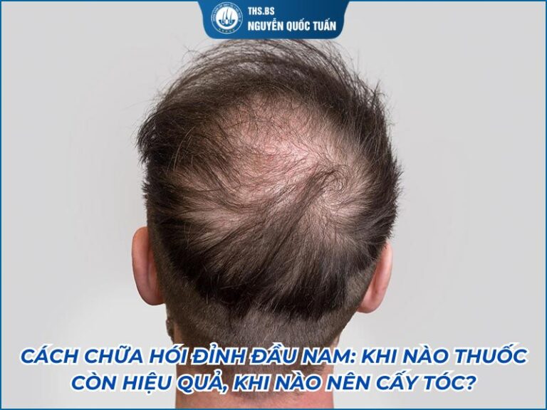 cách chữa hói đỉnh đầu nam