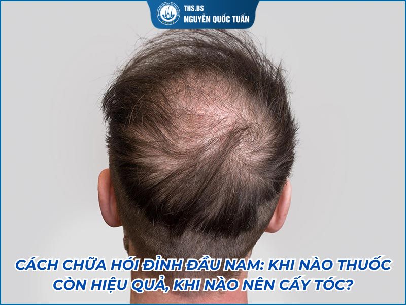 cách chữa hói đỉnh đầu nam