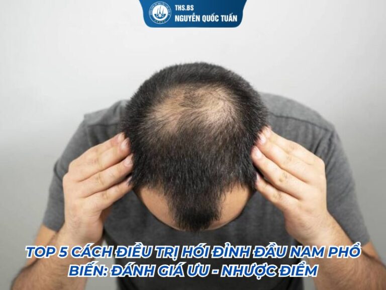 cách điều trị hói đỉnh đầu nam