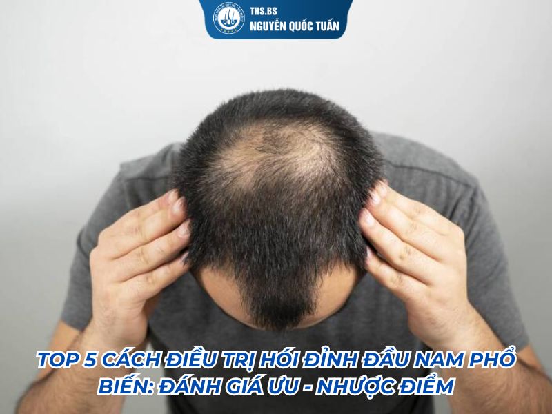 cách điều trị hói đỉnh đầu nam