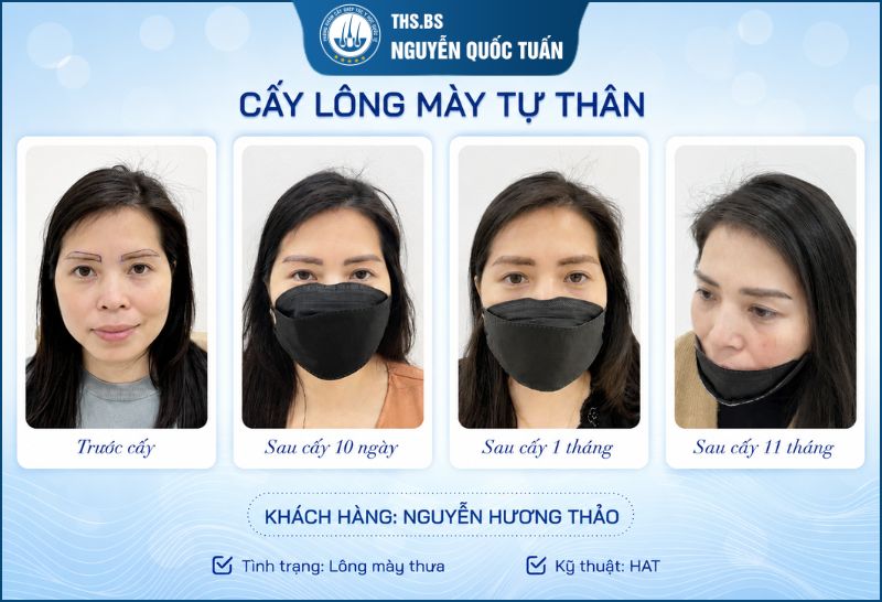 Kết quả cấy lông mày tự thân tại Phòng Khám Cấy Tóc Y Học Quốc Tế  