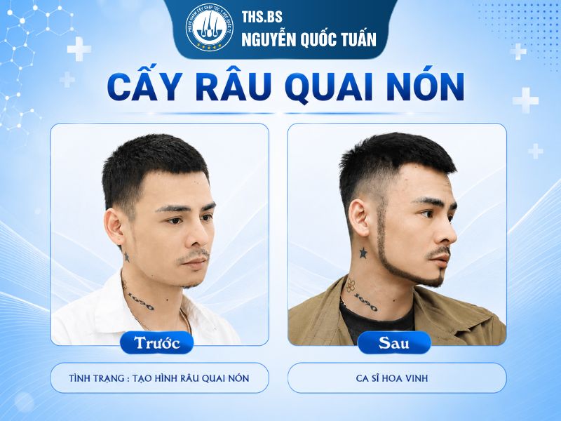 Kết quả cấy râu Ca sĩ Hoa Vinh  