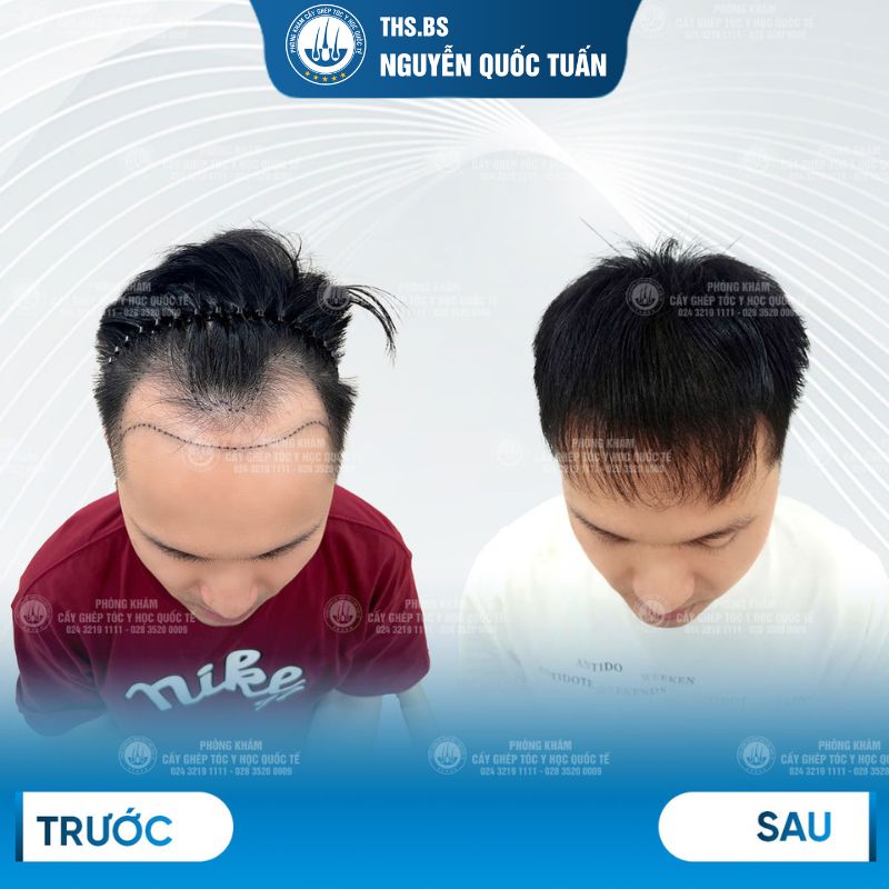 Kết quả cấy tóc chữ M Phòng Khám cấy tóc Y Học Quốc Tế 
