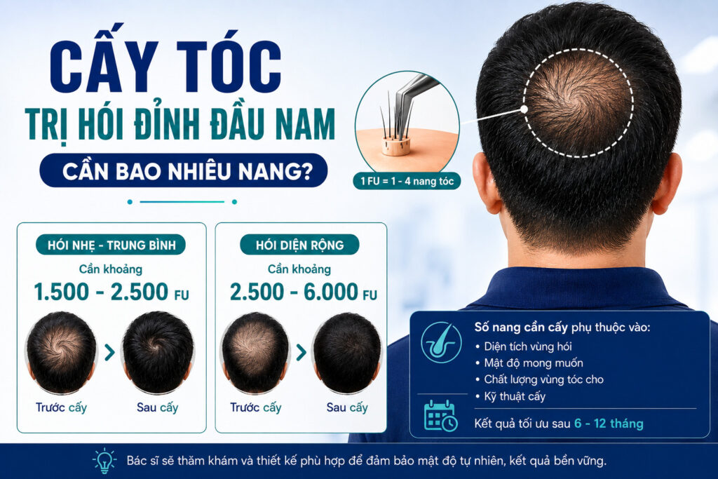 Cấy tóc trị hói đỉnh đầu nam cần bao nhiêu nang 