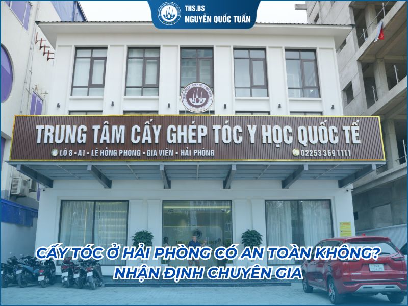 cấy tóc ở hải phòng có an toàn không