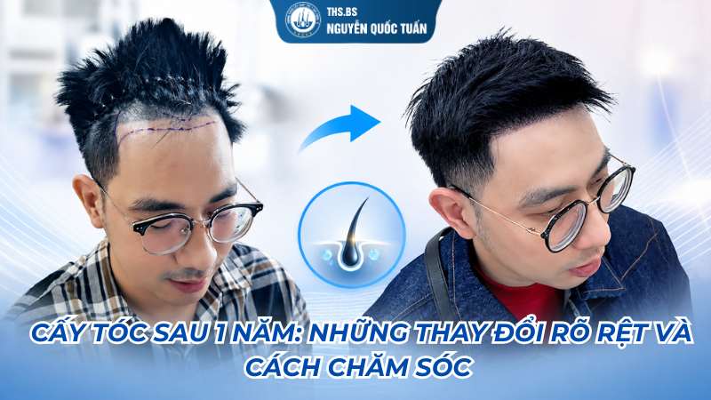 cấy tóc sau 1 năm
