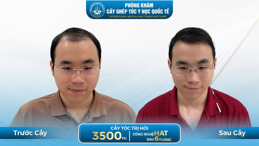 cấy tóc sau 6 tháng 