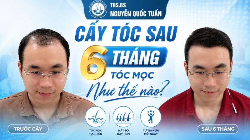 cấy tóc sau 6 tháng