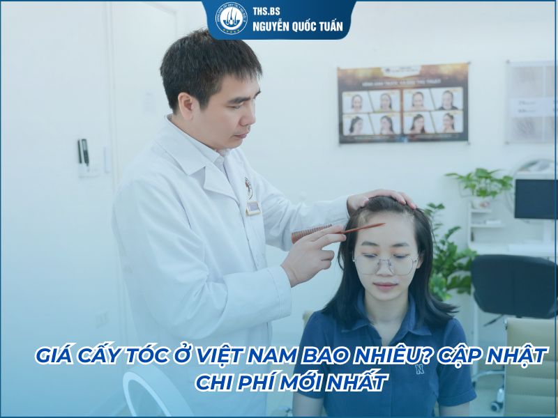cấy tóc việt nam giá bao nhiêu