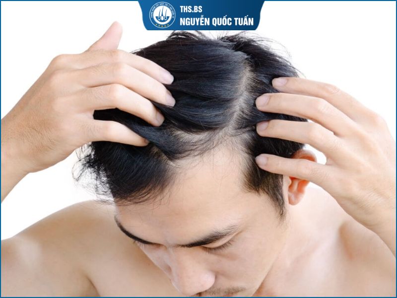  Chữa hói đầu cho nam có thực sự hiệu quả? 