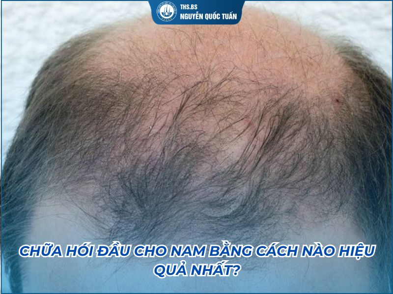 chữa hói đầu nam