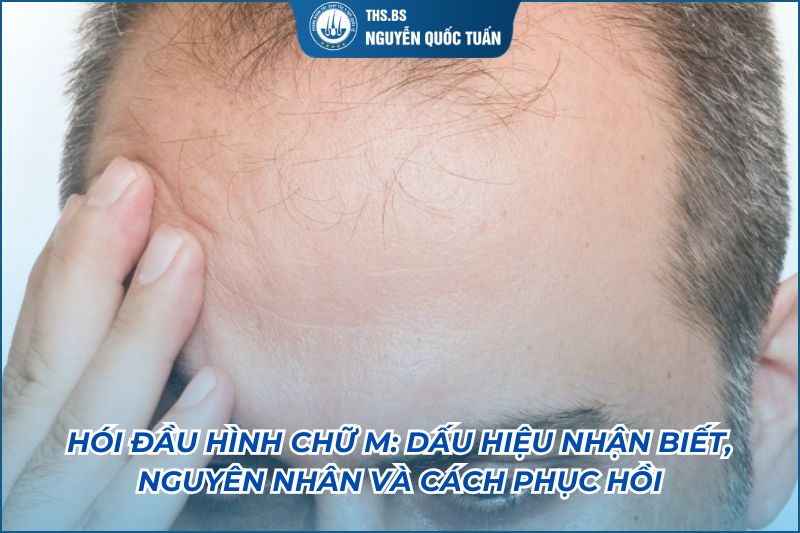 hói chữ m