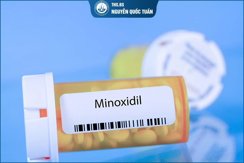 Điều trị hói chữ M bằng thuốc khi nang tóc còn hoạt động 