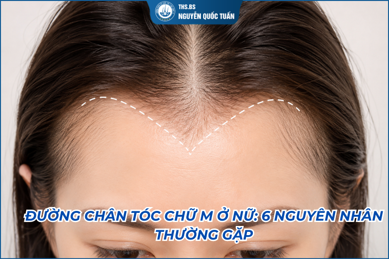 đường chân tóc chữ m nữ