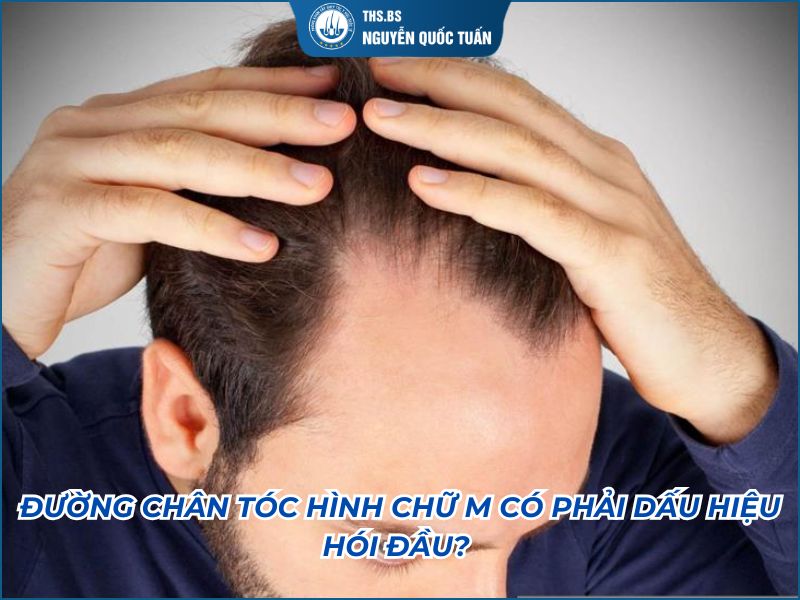 đường chân tóc hình chữ ,m