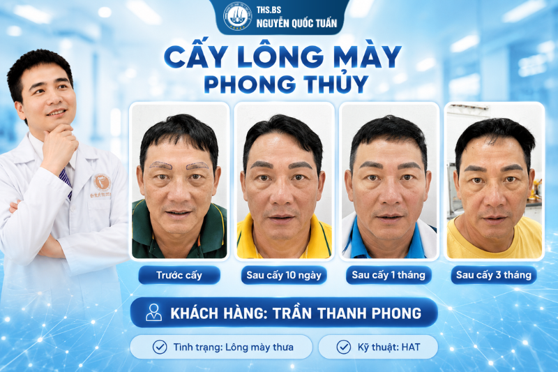 Sau cấy lông mày, từng giai đoạn sẽ thay đổi như thế nào