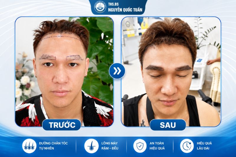 Cấy lông mày tại Phòng khám Cấy ghép tóc Y học Quốc tế