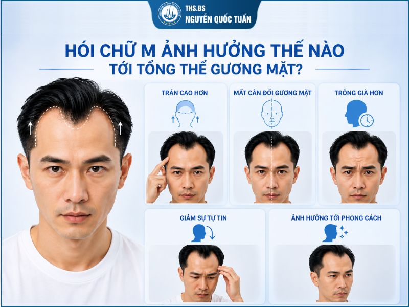 Hói chữ M ảnh hưởng thế nào tới tổng thể gương mặt 
