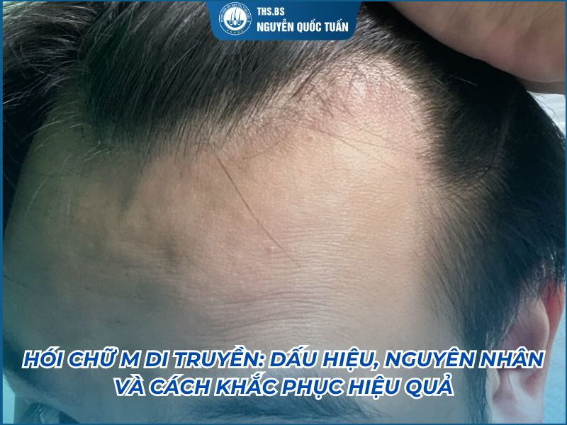 Hói chữ M di truyền