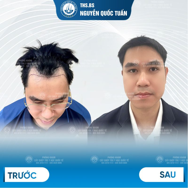 Hiệu quả phương pháp cấy tóc tự thân  
