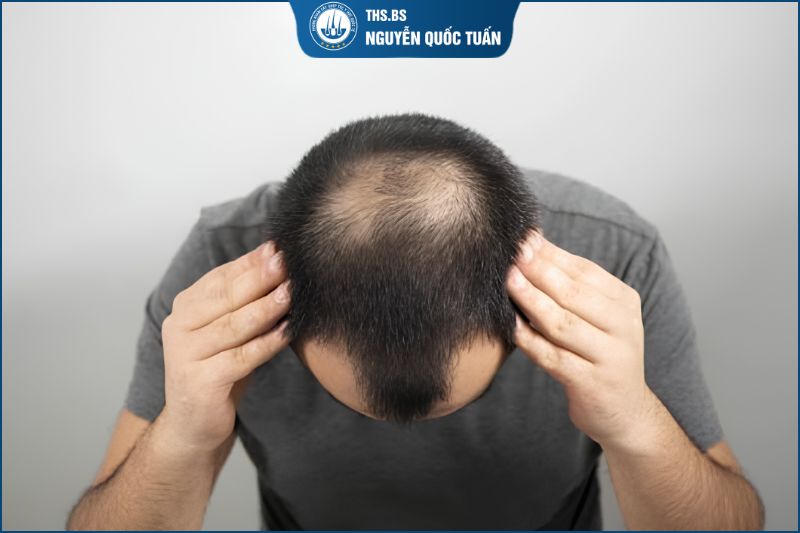 Hói chữ O là gì? Dấu hiệu nhận biết sớm 