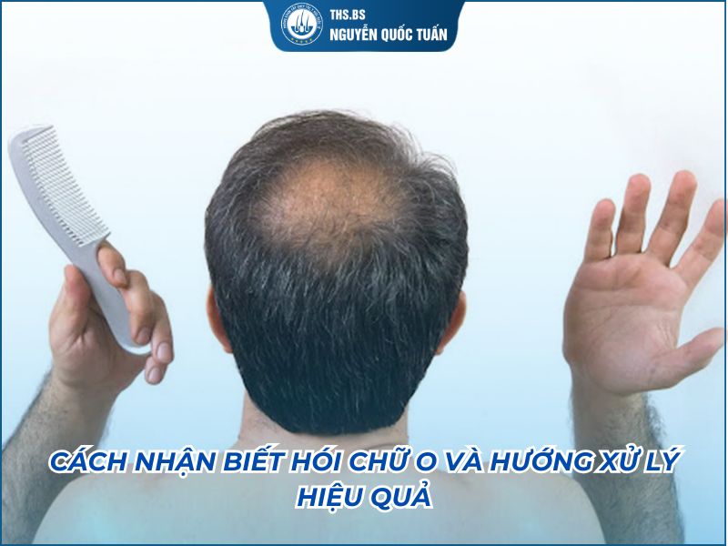 hói chữ o