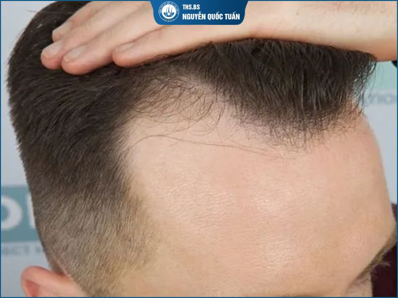  Bị hói chữ M nên làm gì để tình trạng không lan nhanh 