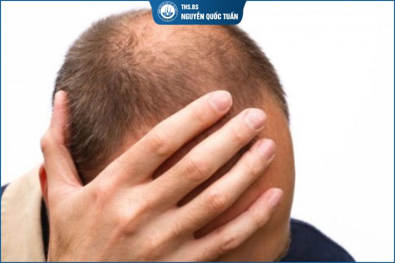 Hói đầu do tuổi cao 
