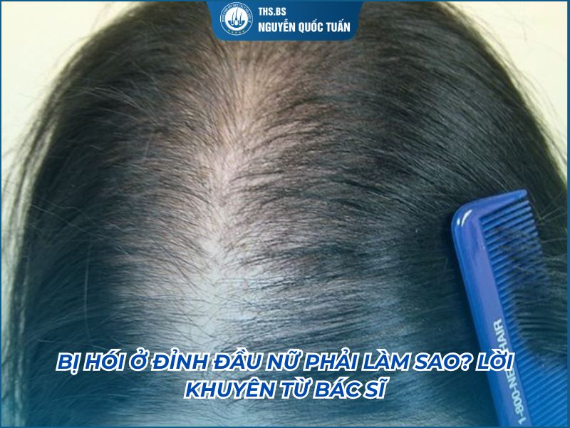 hói đỉnh đầu nữ phải làm sao