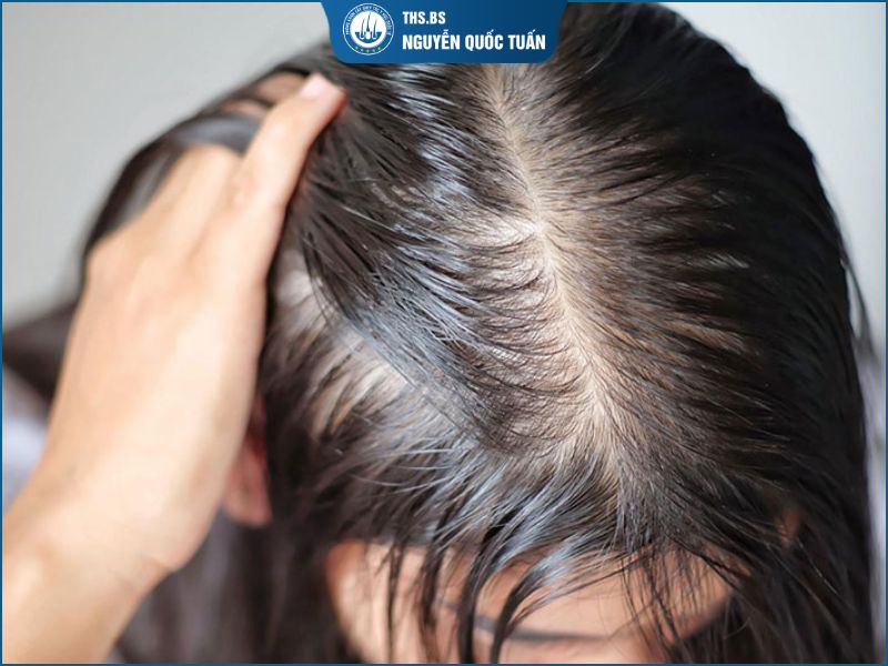 Dấu hiệu nhận biết hói đỉnh đầu nữ  