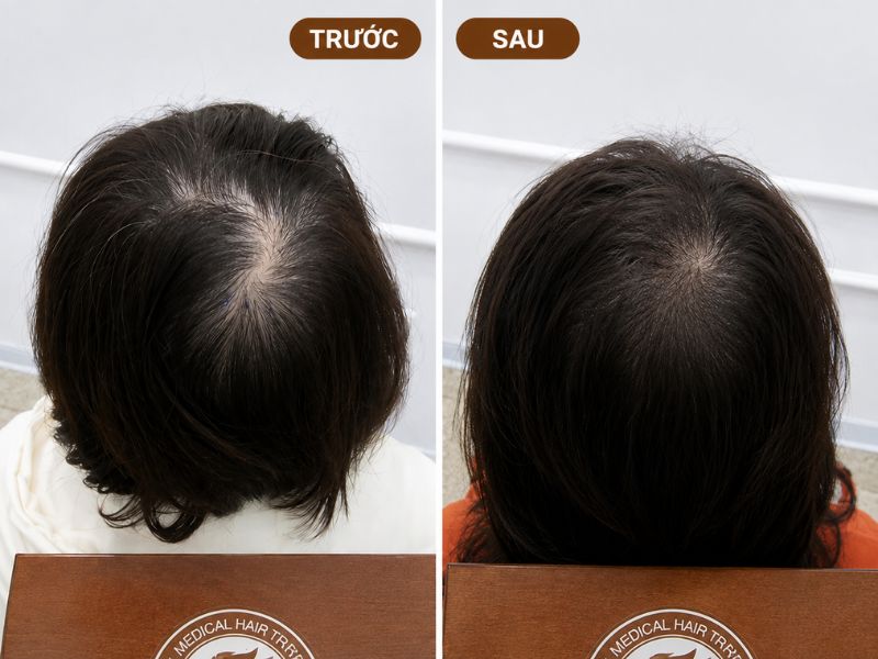 Kết quả cấy tóc hói đỉnh đầu nữ  