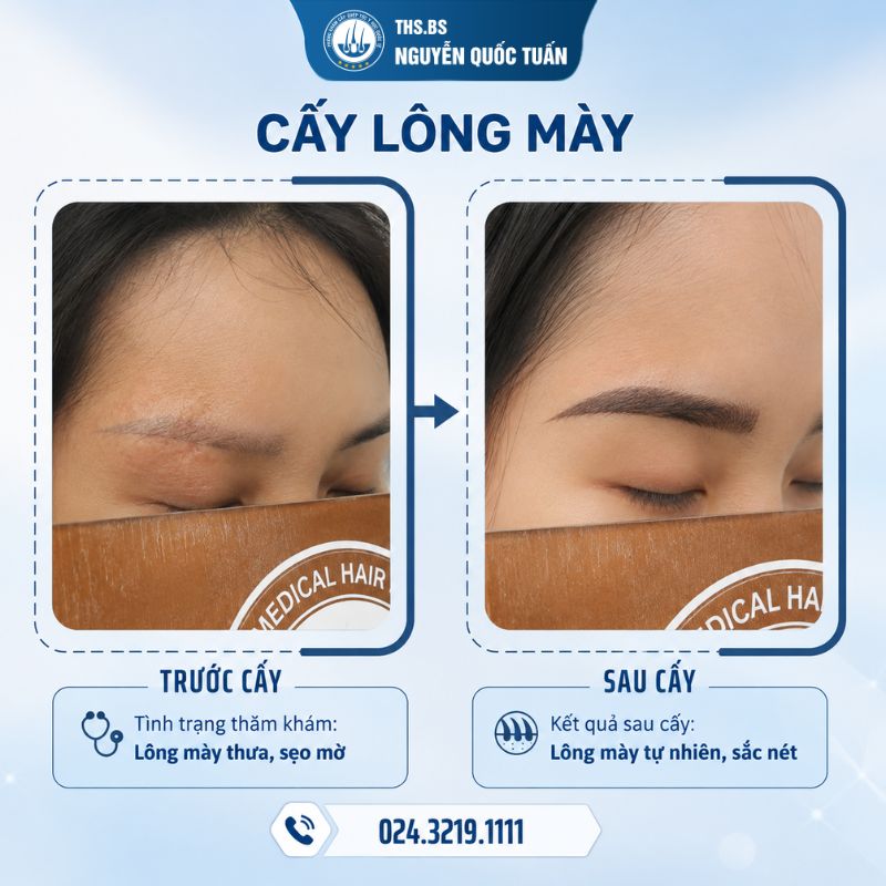 Kết quả cấy lông mày tại Phòng Khám Cấy Ghép Tóc Y Học Quốc Tế