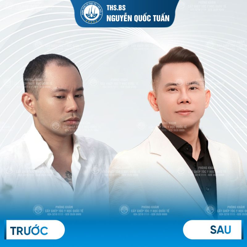 kết quả cấy tóc ca sĩ lê bảo bình