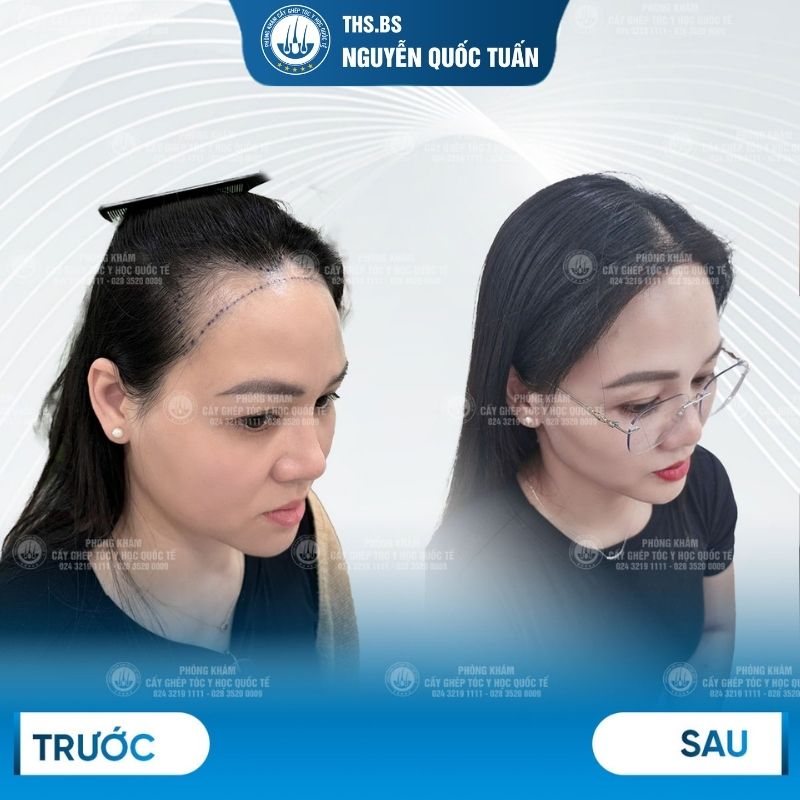 Kết quả sau cấy tại Phòng Khám Cấy Tóc Y Học Quốc Tế  