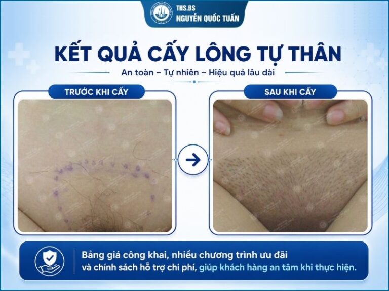 Địa chỉ cấy lông vùng kín uy tín 