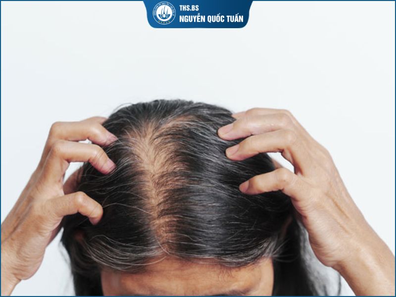 Khi nào tóc thưa đỉnh đầu nữ không nên chỉ dùng kiểu tóc để che? 
