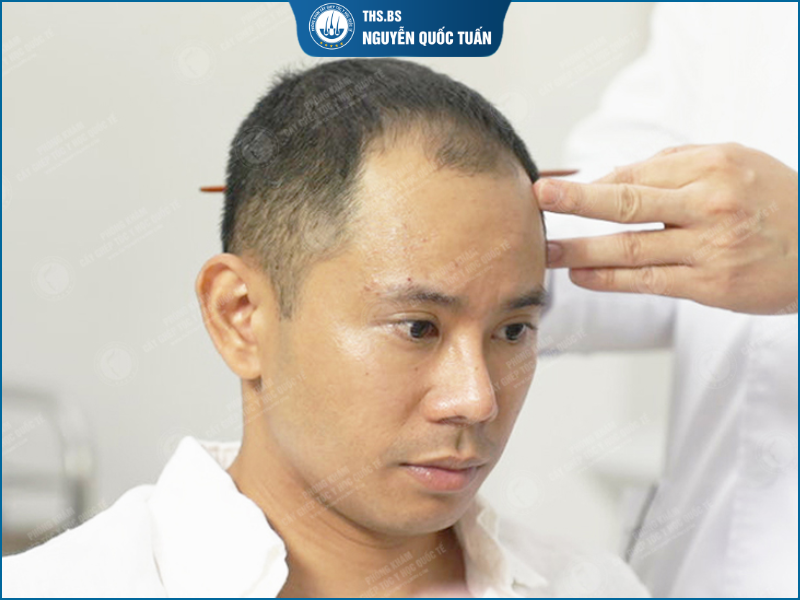 Khi nào nam giới nên đi khám thay vì tự chữa hói tại nhà? 