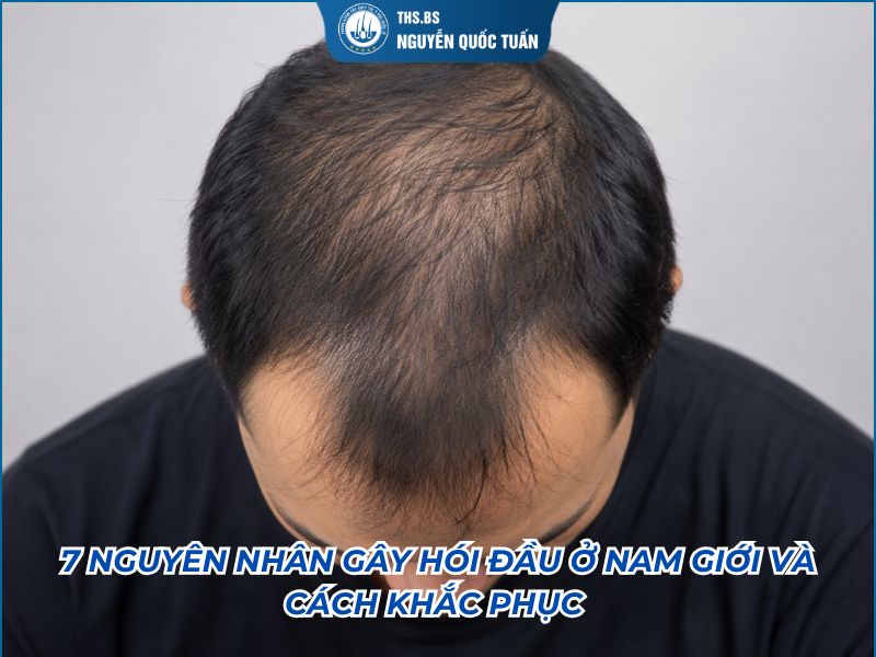 nguyên nhan hói đầu nam giới