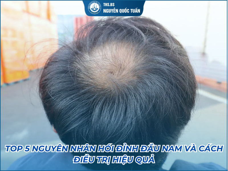 nguyên nhân hói đỉnh đầu nam