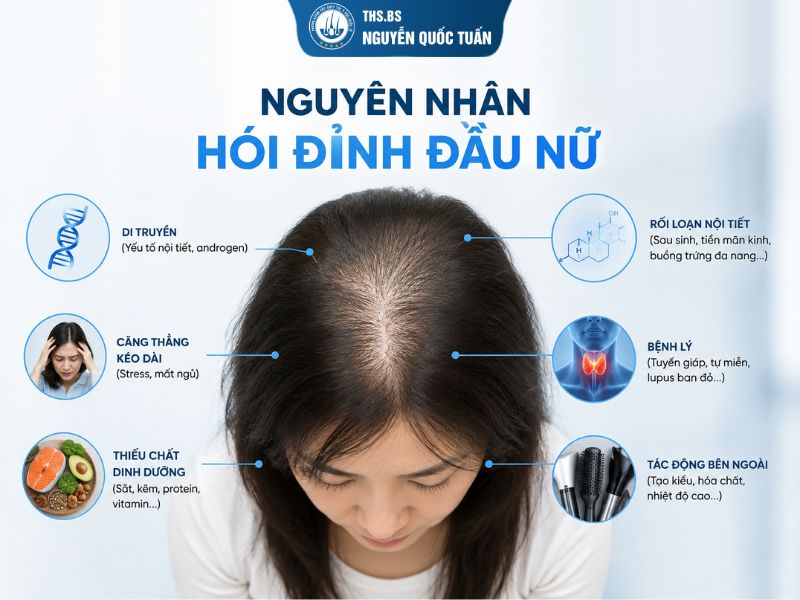 Nguyên nhân hói đỉnh đầu nữ 